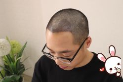 -大麦微针植发丨全国连锁