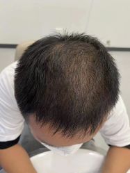 点击看大图 体验后-大麦微针植发全国连锁