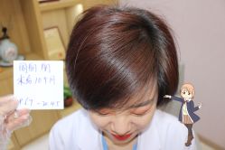 -大麦微针植发丨全国连锁