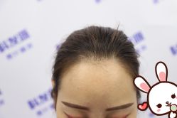 点击看大图 -大麦微针植发丨全国连锁