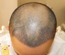 -大麦微针植发丨全国连锁