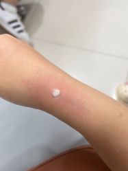 -北京美痣堂古方祛痣斑疣瘊