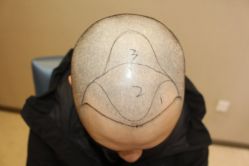 -大麦微针植发丨全国连锁