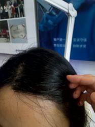 -碧莲盛·不剃发植发