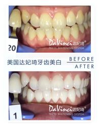 牙齿美白-光SPA科技美肤