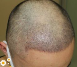 -大麦微针植发丨全国连锁