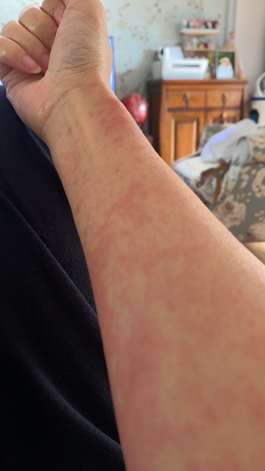 跟朋友一起来吃,吃过第二天早上起严重过敏