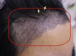 -大麦微针植发全国连锁