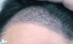 -大麦微针植发丨全国连锁