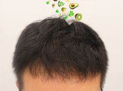 -大麦微针植发全国连锁