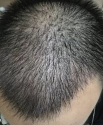 -大麦微针植发丨全国连锁