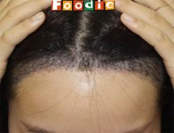 -大麦微针植发全国连锁