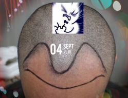 -大麦微针植发全国连锁