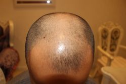 -大麦微针植发丨全国连锁