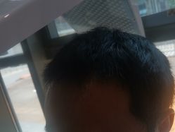 -碧莲盛·不剃发植发