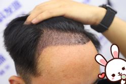 -大麦微针植发丨全国连锁