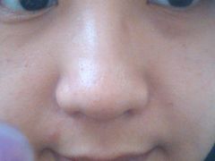 今天已经消肿不少了-上海华安整形外科门诊部