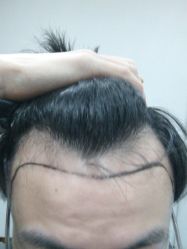 -碧莲盛·不剃发植发