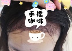 -大麦微针植发全国连锁