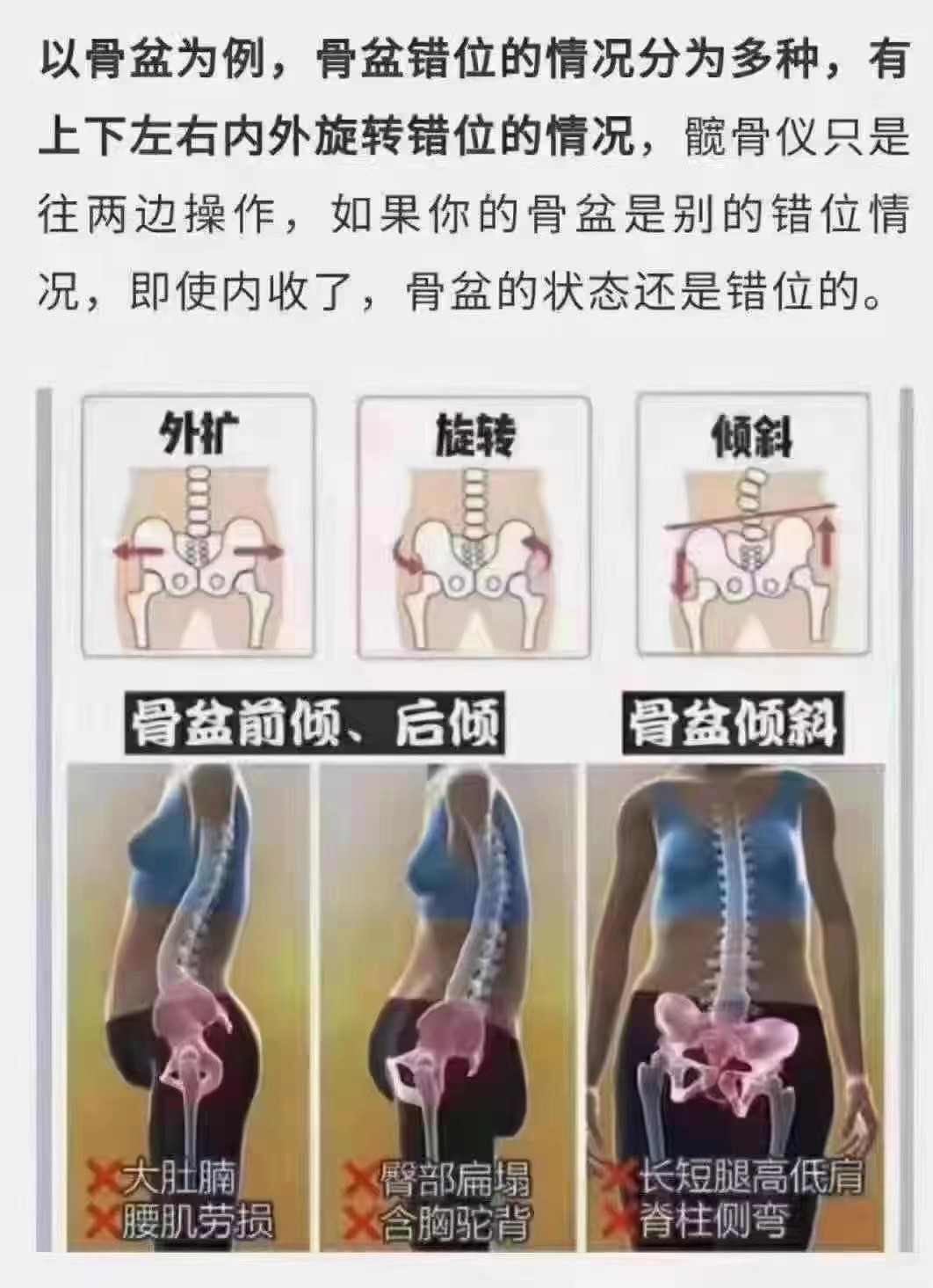 产后大转子骨外凸图片