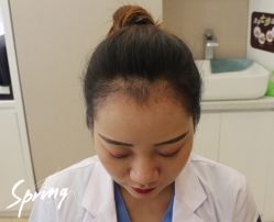 -大麦微针植发全国连锁