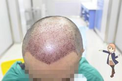 -大麦微针植发丨全国连锁