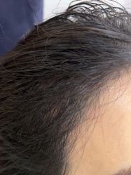 体验后-熙朵美学植发·连锁品牌