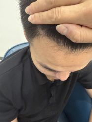-大麦微针植发全国连锁
