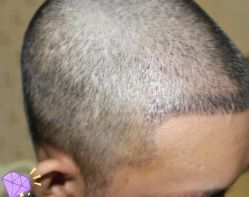 -大麦微针植发丨全国连锁