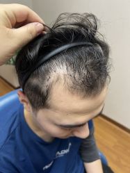 体验前-大麦微针植发全国连锁