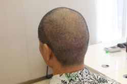 -大麦微针植发丨全国连锁