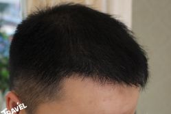 -大麦微针植发丨全国连锁