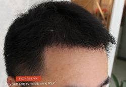 -大麦微针植发丨全国连锁