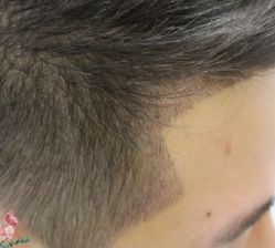 -大麦微针植发丨全国连锁