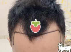 -大麦微针植发全国连锁