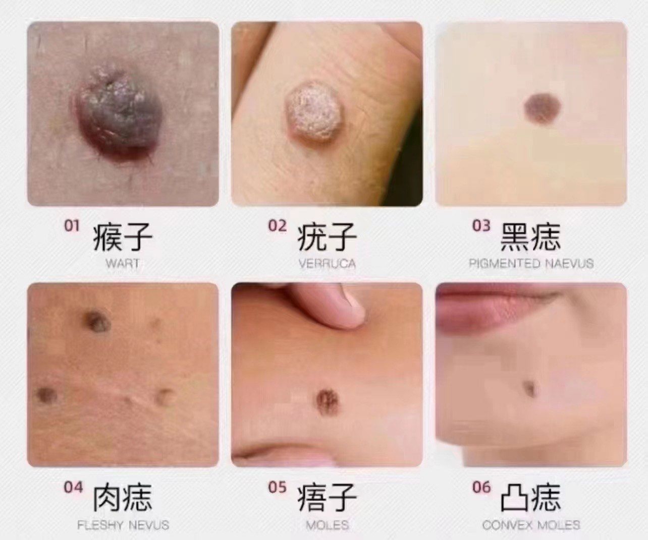 🍀【痣,疣分享】温馨提醒:
身上的