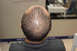 -大麦微针植发全国连锁