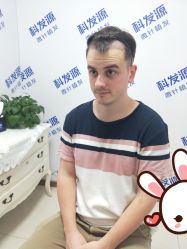 点击看大图 -大麦微针植发丨全国连锁