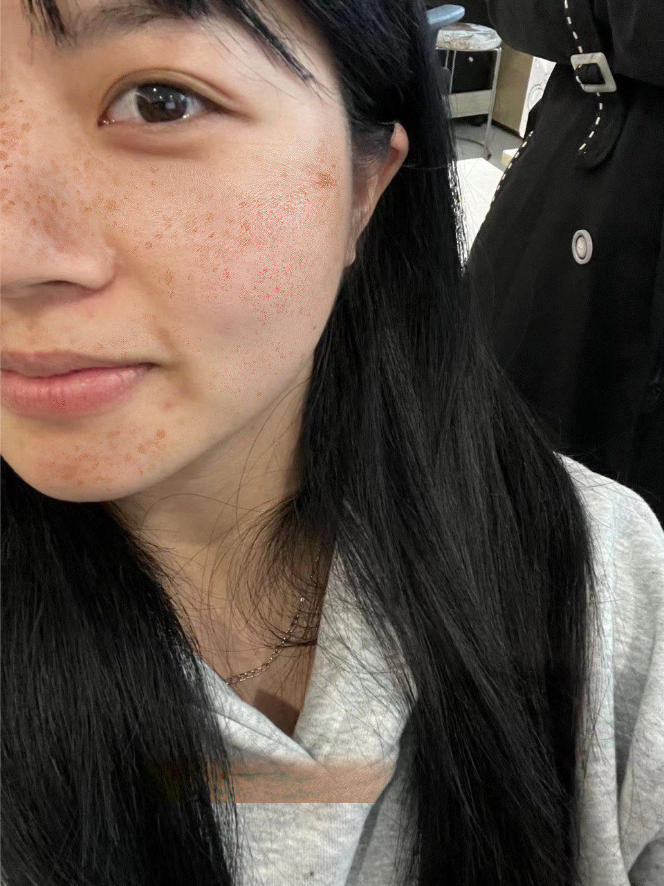 发现脸上长斑真的慌得不行,乖乖做医美,分分钟就把斑点消灭了!