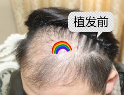 -大麦微针植发全国连锁