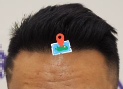 -大麦微针植发全国连锁