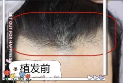 -大麦微针植发全国连锁