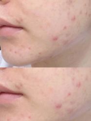 -苗方清颜痘肌研究所