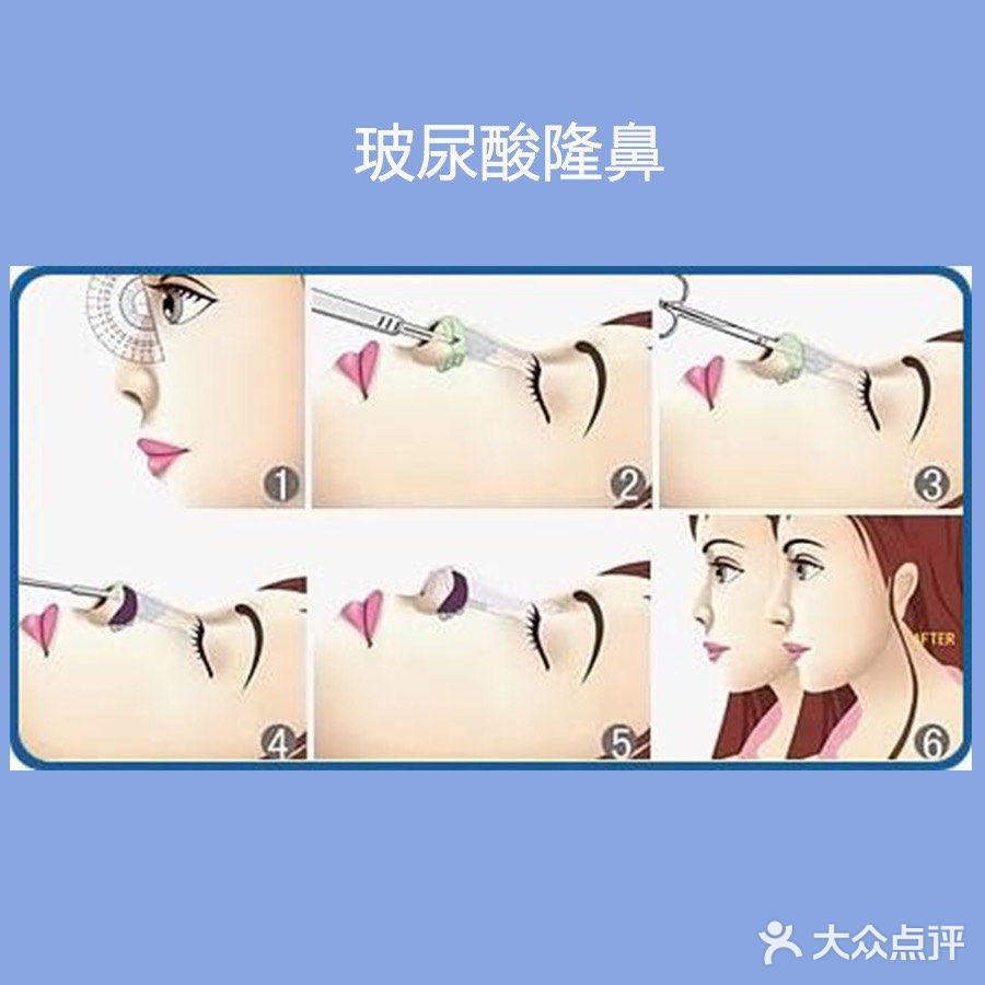 害怕手术的看过来！非手术隆鼻法介绍～