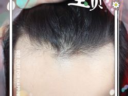 -大麦微针植发全国连锁