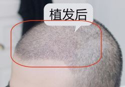 -大麦微针植发全国连锁