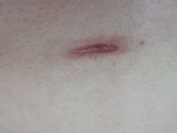 -成都军建医院·疤痕诊疗中心