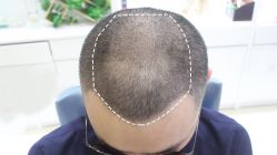 -大麦微针植发丨全国连锁