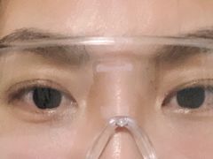 -黑马眼科·近视手术