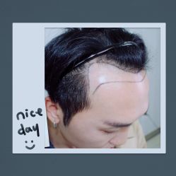 -大麦微针植发全国连锁